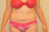 Liposuction of the abdomen