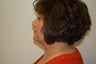 Liposuction Neck