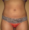 Liposuction