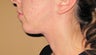 Chin Liposuction