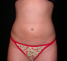 Liposuction