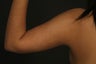 Liposuction