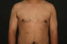 Gynecomastia