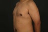 Gynecomastia