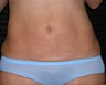 Liposuction