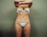 Liposuction