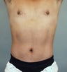 Liposuction