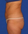 Liposuction, SmartLipo™