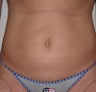 Liposuction