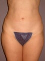 Liposuction