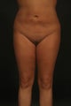 Liposuction