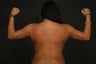 Liposuction
