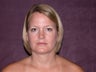 Neck Liposuction