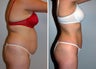 Liposuction