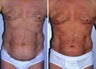 Liposuction