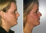 Liposuction of the neck