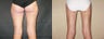 Liposuction