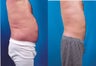 Male Liposuction