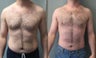 Liposuction