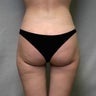 Liposuction