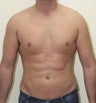 Liposuction