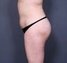 Liposuction