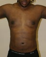 male liposuction