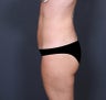 Liposuction