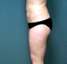 Liposuction