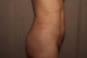 Liposuction