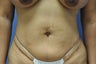 Liposuction