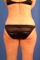 Liposuction