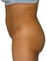 Liposuction
