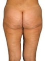 Liposuction
