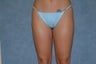 Liposuction