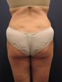 Back liposuction