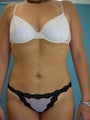 Liposuction