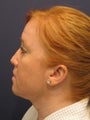 Neck liposuction
