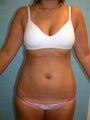Liposuction of abdomen back and thighs