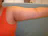 Liposuction of arms