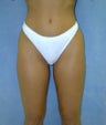 Liposuction