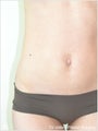 Liposuction