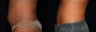 Liposuction