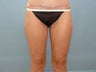 Liposuction