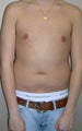Liposuction