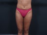 Liposuction