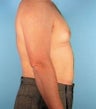 Liposuction
