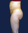 liposuction