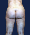 liposuction