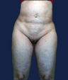 liposuction